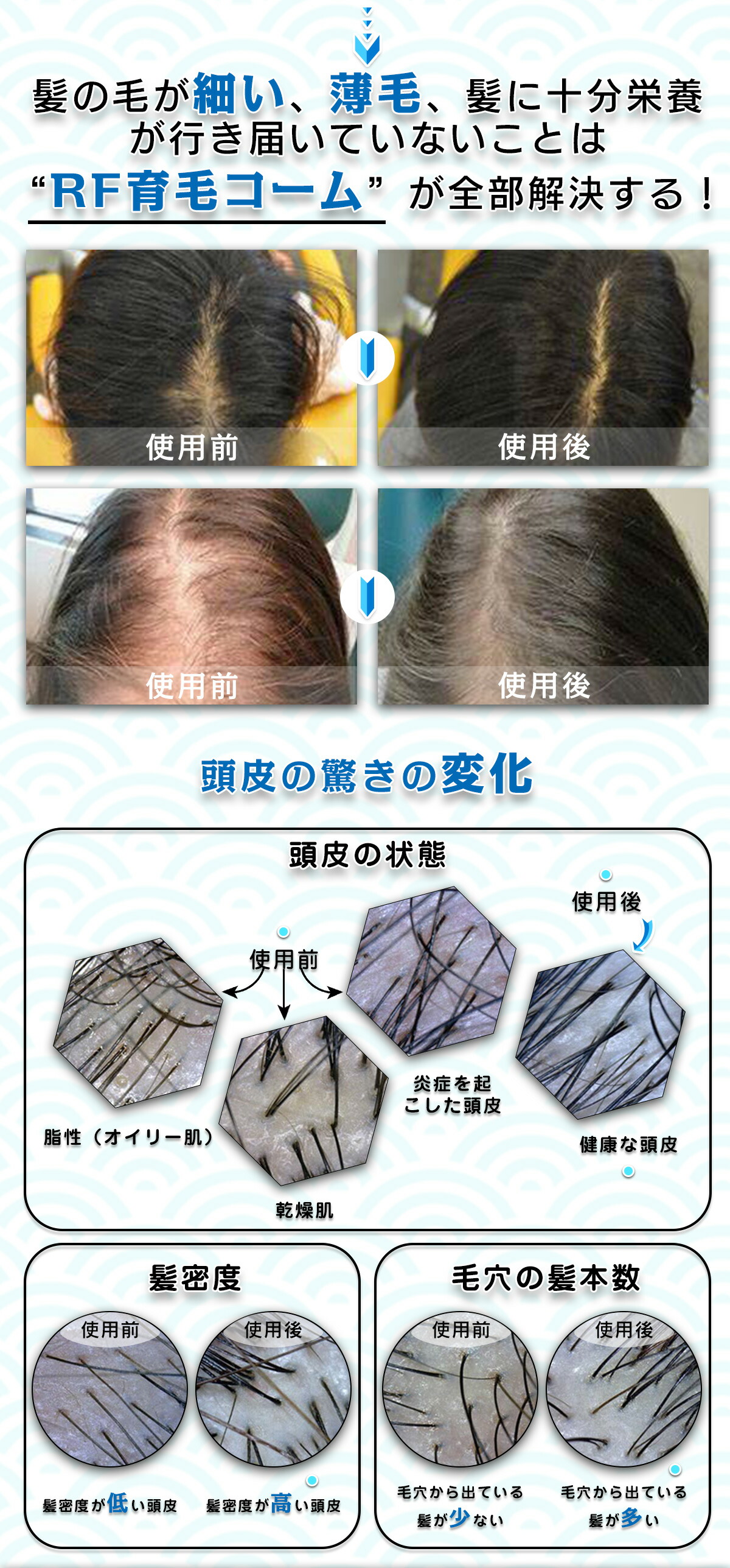 頭皮ケア ヘッドケア ヘッドスパ RF頭皮ブラシ 電動頭皮ブラシ スカルプケア ヘアケア 美髪 美顔器 EMS エレクトロポレーション 頭皮 男女兼用 プレゼント ホワイトデー 薄毛対策 頭皮ケア ヘッドケア ヘッドスパ RF頭皮ブラシ 電動頭皮ブラシ スカルプケア ヘアケア 美髪 美顔器 EMS エレクトロポレーション 頭皮 男女兼用 プレゼント ホワイトデー 薄毛対策