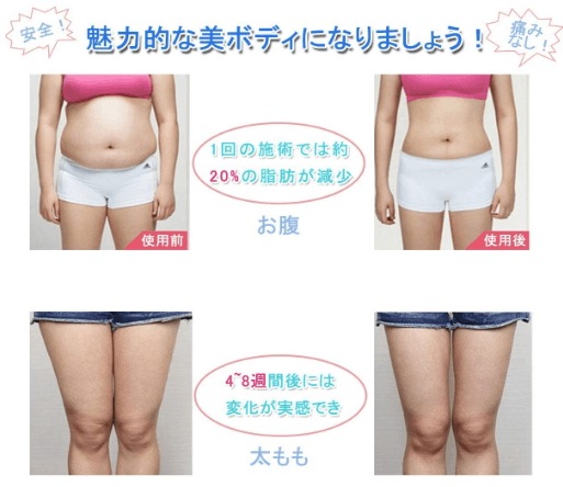 家庭キャビテーション 冷凍ダイエットマシン 脂肪冷却 セルライト痩身マシン 腹部 太もも お腹 お尻 背中 ヒップ キャビテーション 自宅 簡単本格エス 家庭キャビテーション 冷凍ダイエットマシン 脂肪冷却 セルライト痩身マシン 腹部 太もも お腹 お尻 背中 ヒップ キャビテーション 自宅 簡単本格エス