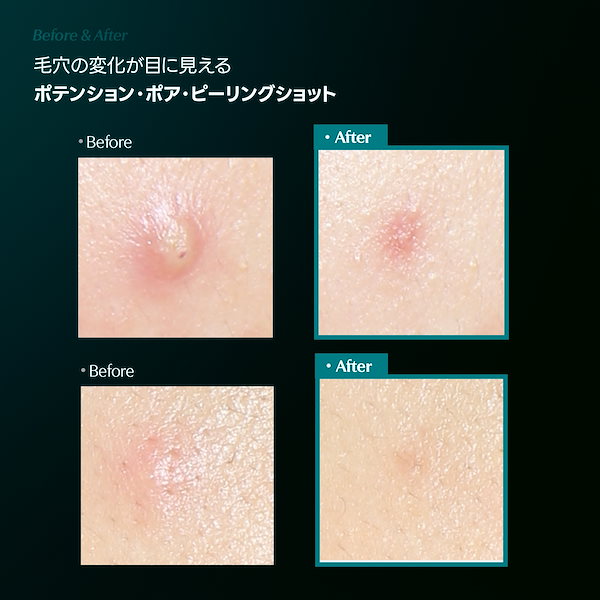 Qoo10] CELORABY 毛穴でSNS話題のアレ！ポテンションポア