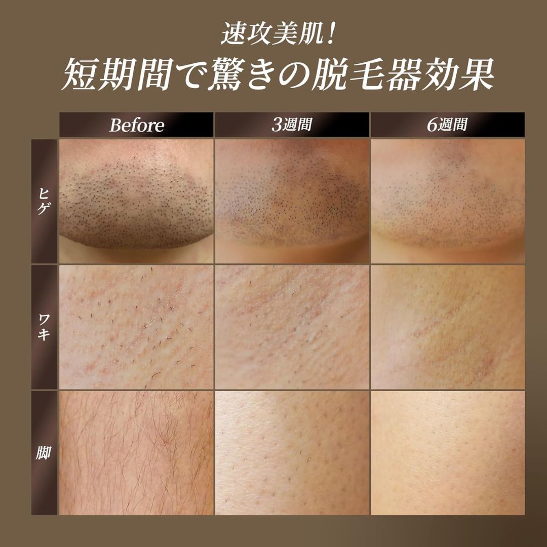 【圧倒的パワー】W冷却 濃いヒゲ VIO ムダ毛 全身スベスベ肌へ 脱毛器 BR4011 圧倒的パワー】W冷却 濃いヒゲ VIO ムダ毛 全身スベスベ肌へ 脱毛