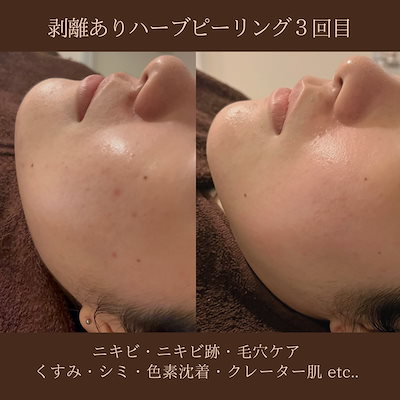 ハーブピーリング  剥離あり　皮向けあり　10回分→10g ハーブピーリング 剥離あり 皮向けあり 10回分→10g （海外通販