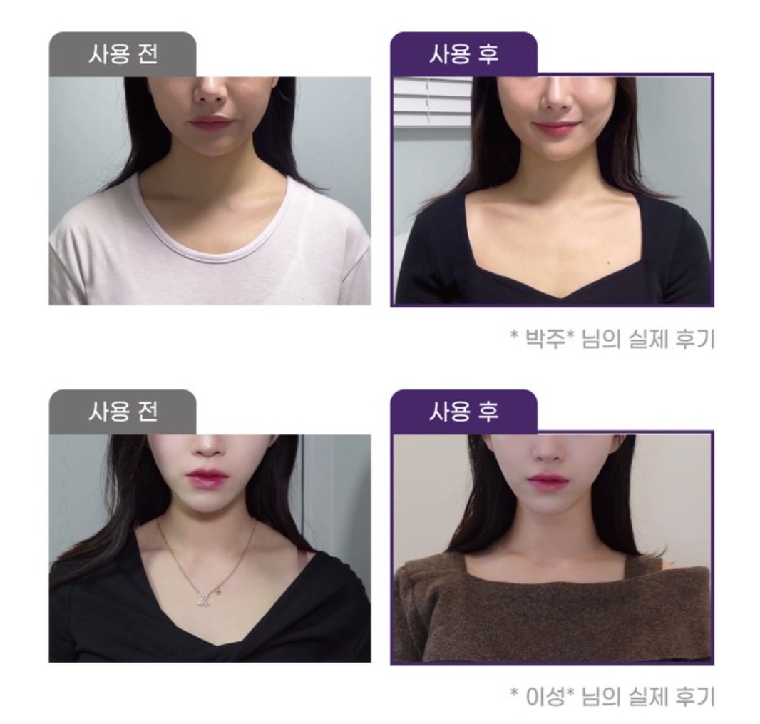 エセライト僧帽パッチ14個入り1ボッ