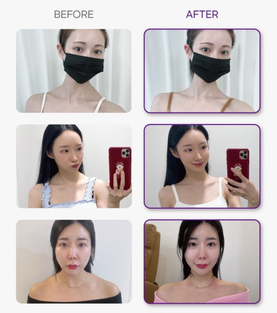 エセライト僧帽パッチ14個入り1ボッ