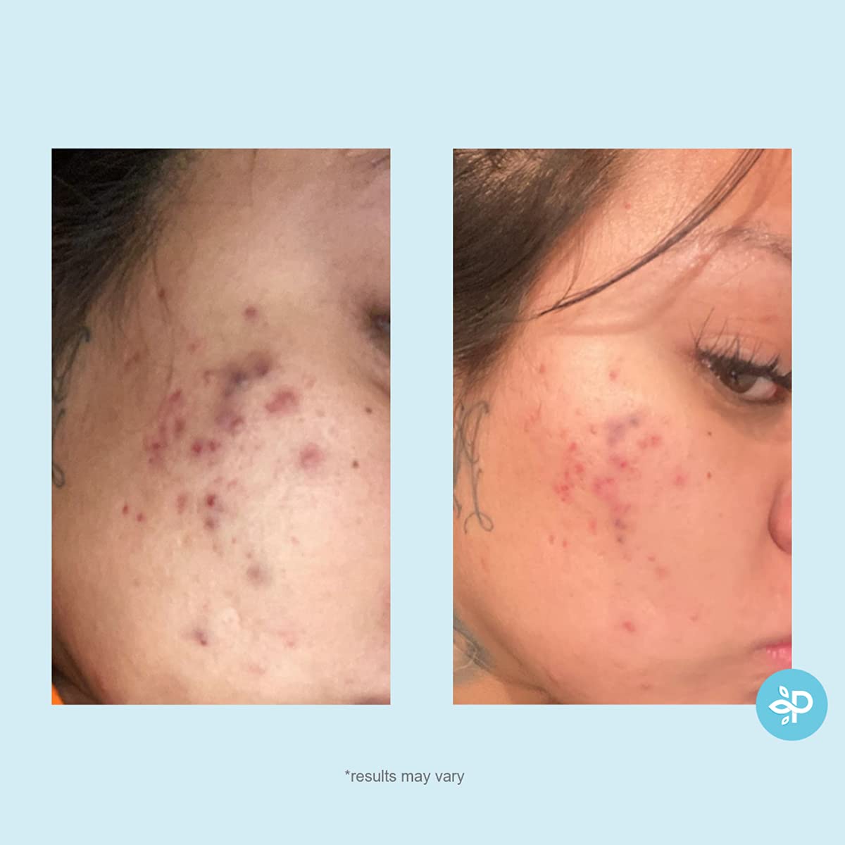 サリチル20%ジェルピールブレイクアウト毛穴ミニマイズとクレンザー強度レベル21530フルフェイスケミカルピール1フローズ30ml