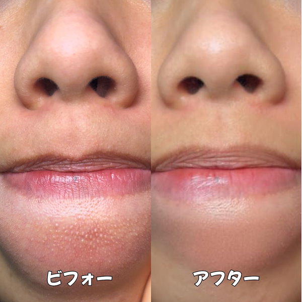 Qoo10] ODELOI オドロイ 弱酸性毛穴収縮ニドソープ Lo