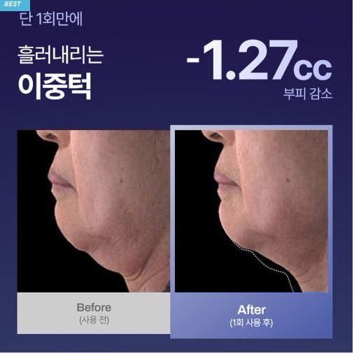 メディテラピー インモトックス ペプチドショットクリーム 脂肪吸引デバイス Qoo10] メディテラピー 【限定数量】【LED美顔器】インモトック