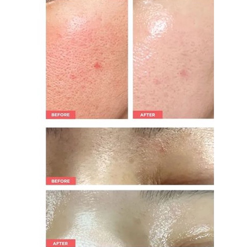 最高の保湿力 高機能 美容液 濃密 保湿 アトピー 肌バリア 乾燥 敏感肌 低刺激 エクトイン アンプル 20ea x 1m 肌の赤み美容液 赤ら顔 角質ケア 乳酸菌 パンテノール essello