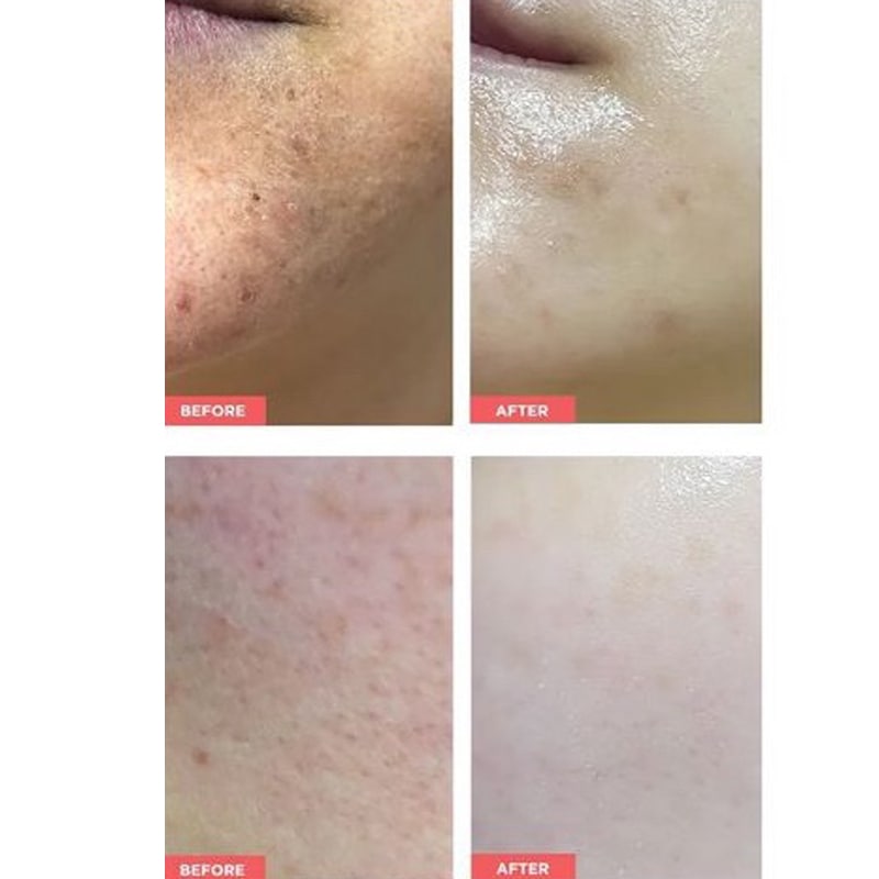 最高の保湿力 高機能 美容液 濃密 保湿 アトピー 肌バリア 乾燥 敏感肌 低刺激 エクトイン アンプル 20ea x 1m 肌の赤み美容液 赤ら顔 角質ケア 乳酸菌 パンテノール essello