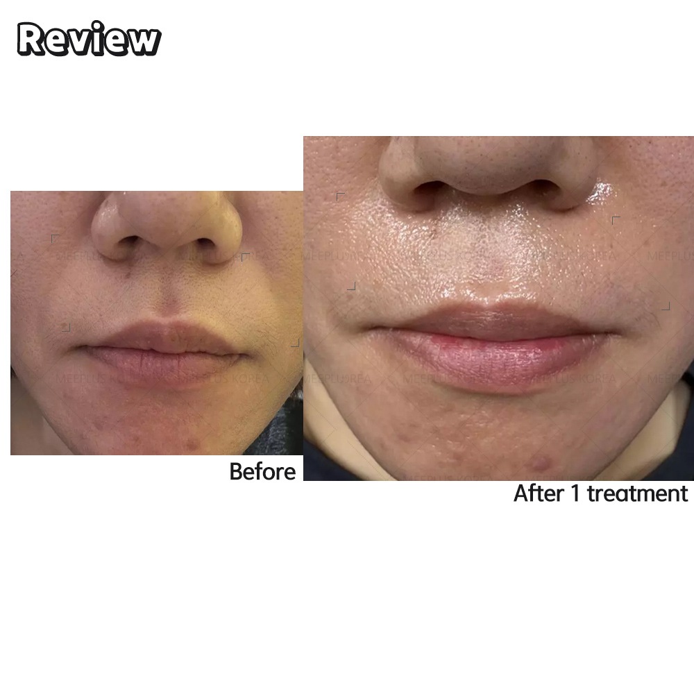 B-TOX マイクロニドリング 7ml *10本セット肌を引き締めハリのある印象へ B-TOX マイクロニドリング 7ml *10本セット肌を引き締めハリのある印象へ