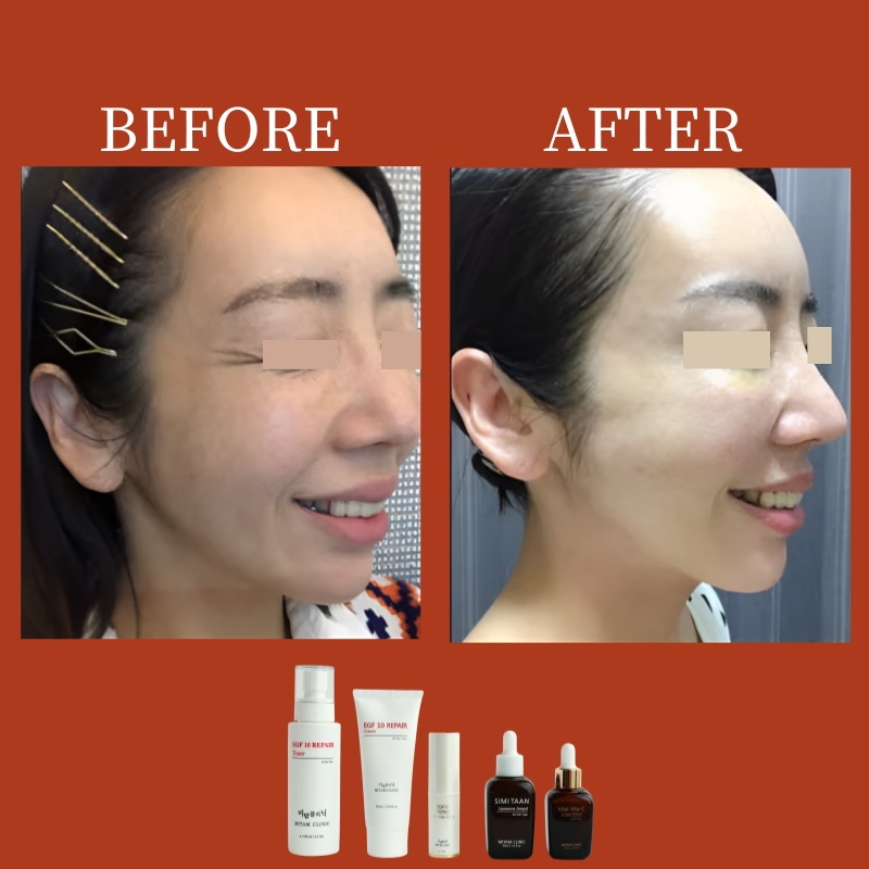 正規品] Mitam Cosme プレミアム スキンケアセット - 天然成分, EGF