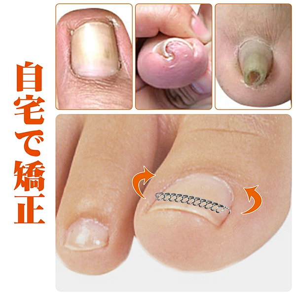 Qoo10] 巻き爪 矯正 巻き爪チェーン ワイヤー