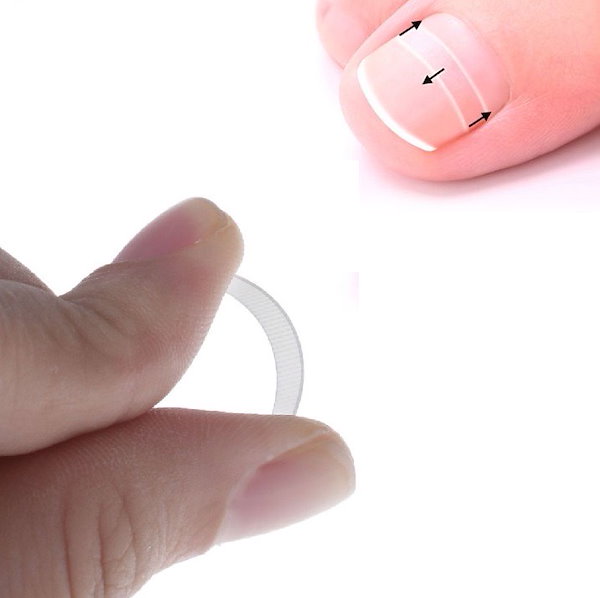 Qoo10] 巻き爪 陥入爪 矯正 サポート ミックス