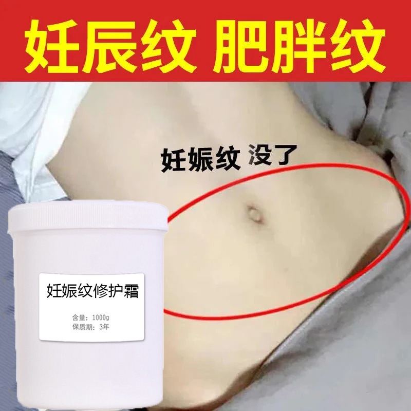ストレッチマーク修復クリーム産後退色妊娠肥満マーク美容室スキンケア予防卸売