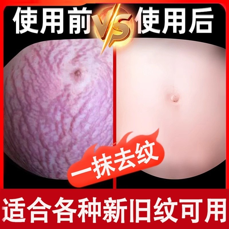 ストレッチマークの産後修復クリーム成長マークの軽減と除去傷跡修復ママの妊娠マーク肌引き締めクリームビューティーサロン