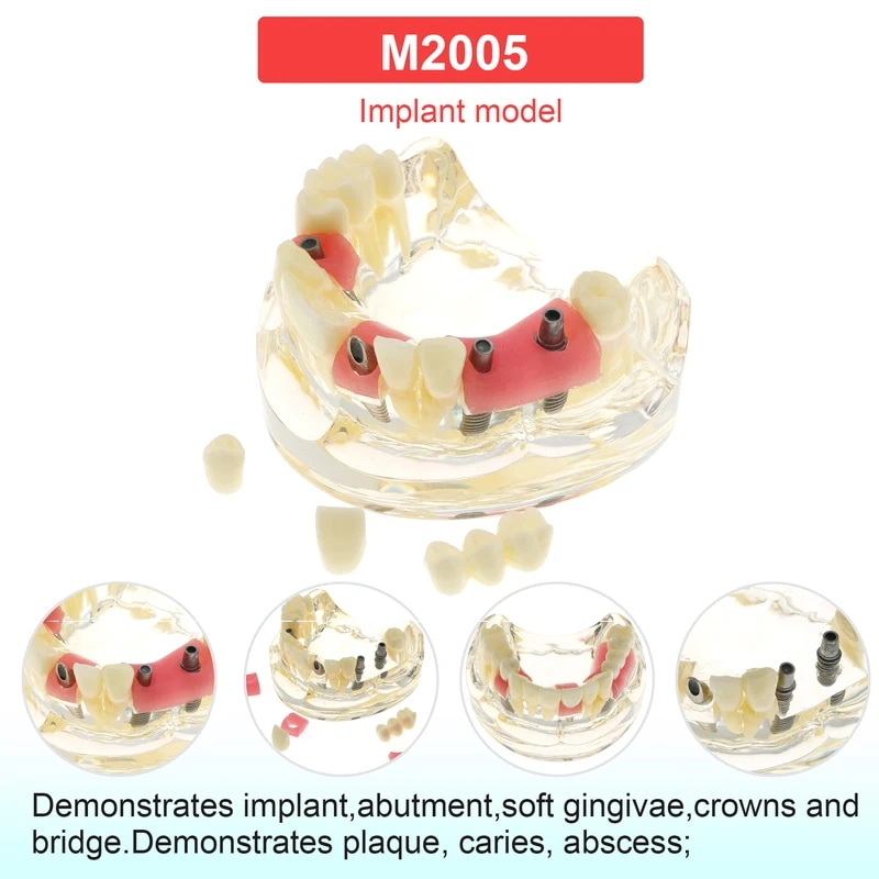 歯のモデル,歯科,教育,トレーニング,学習,患者,取り外し可能なID M2005