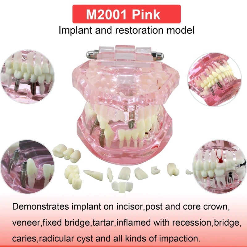 歯のモデル,歯科,教育,トレーニング,学習,患者,取り外し可能なID M2001 Pink