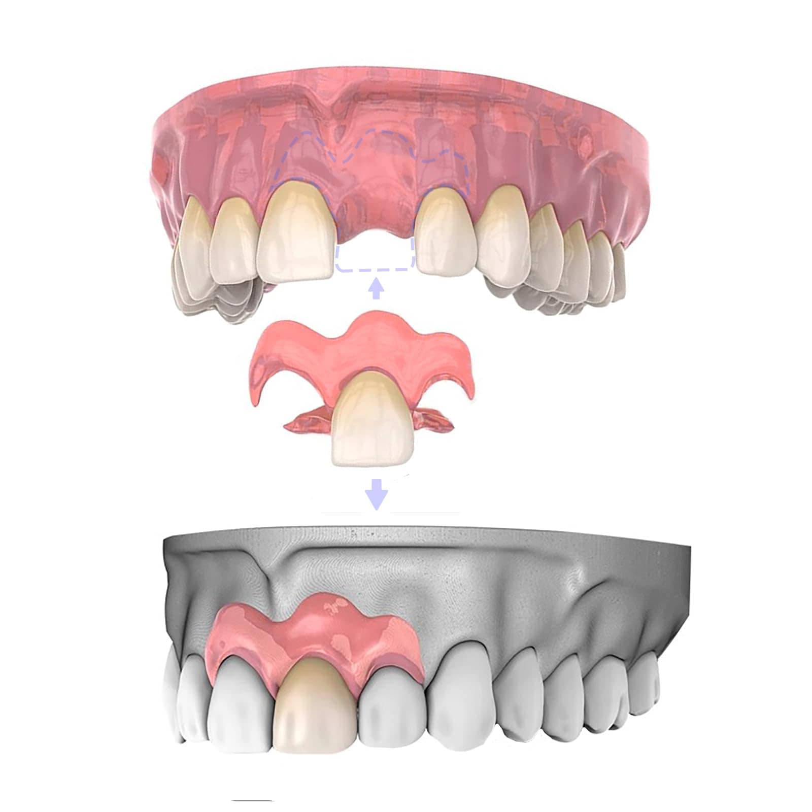 3本 カスタム 入れ歯 部分 取り外し可能 Dentellea 義歯 携帯便利 自然な見た目
