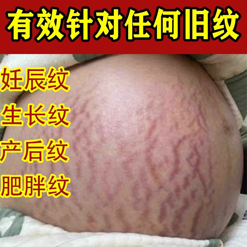 妊娠線修復クリーム 産後妊娠線除去肥満跡予防成長跡お腹引き締め妊娠線除去修復クリーム